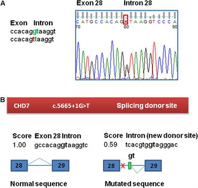 Functional Analyses of a Novel Splice Variant in the CHD7 Gene, Found by Next Generation Sequencing, Confirm Its Pathogenicity in a Spanish Patient and Diagnose Him with CHARGE Syndrome